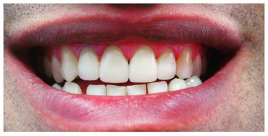 Porcelain crowns after