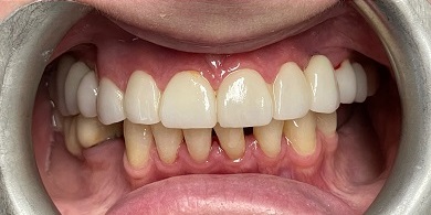 Porcelain crowns after