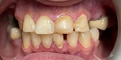 Porcelain crowns before