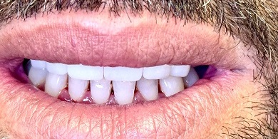 Porcelain crowns after