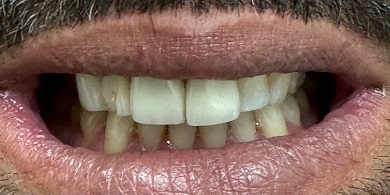 Porcelain crowns before