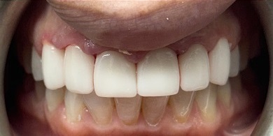 Porcelain crowns after