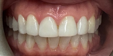 Porcelain crowns before