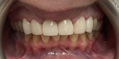 Porcelain crowns after