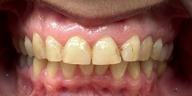 Porcelain crowns before